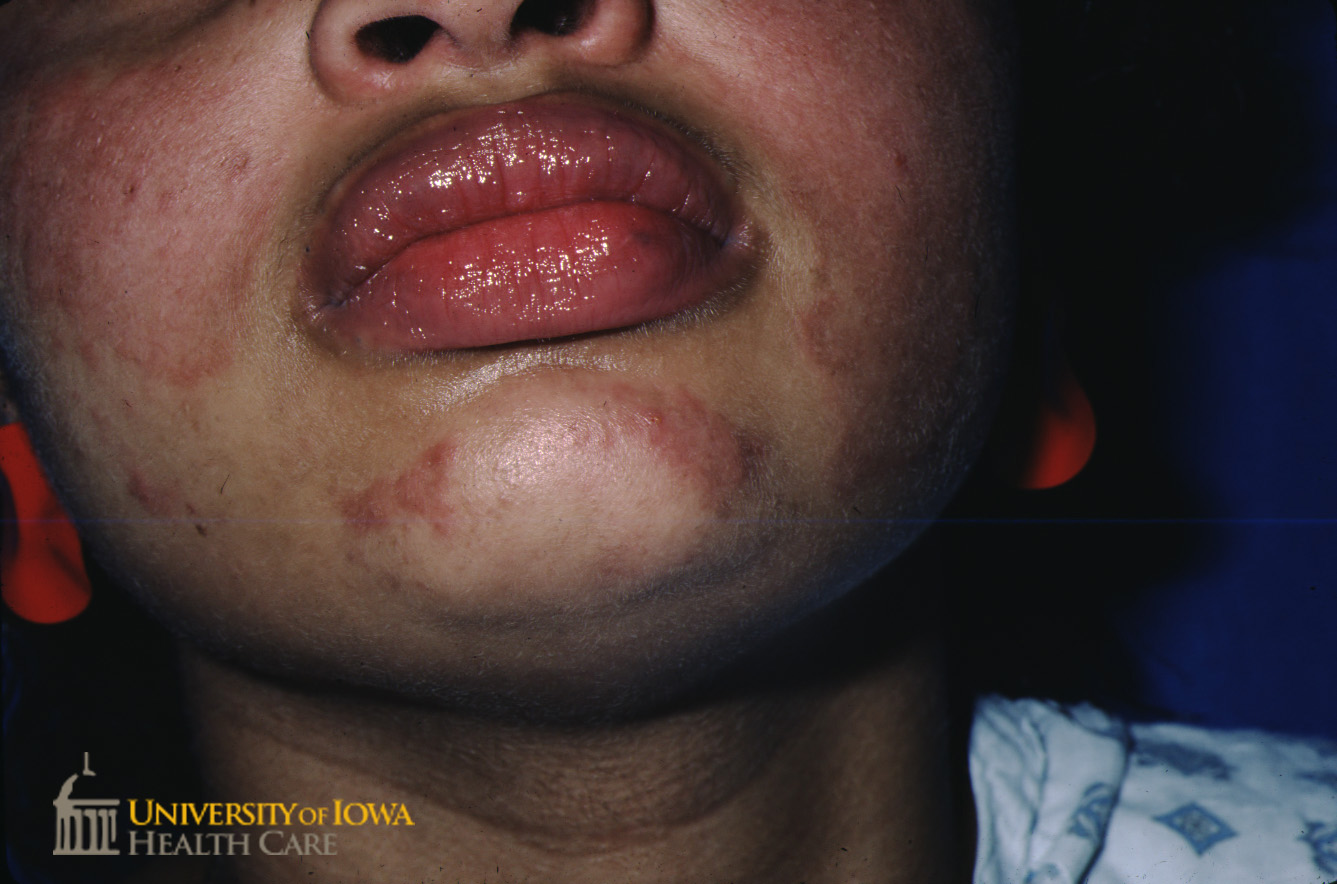 Erythematous plaques on the cheeks, nose, and chin. (click images for higher resolution).